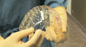 3D принтер напечатал череп: впервые в мире пересажен пластиковый имплантат черепной коробки